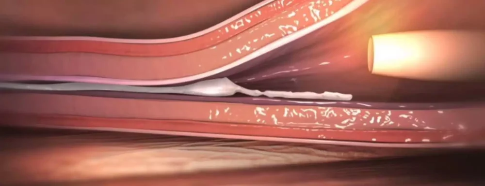 limbehandling aderbrack